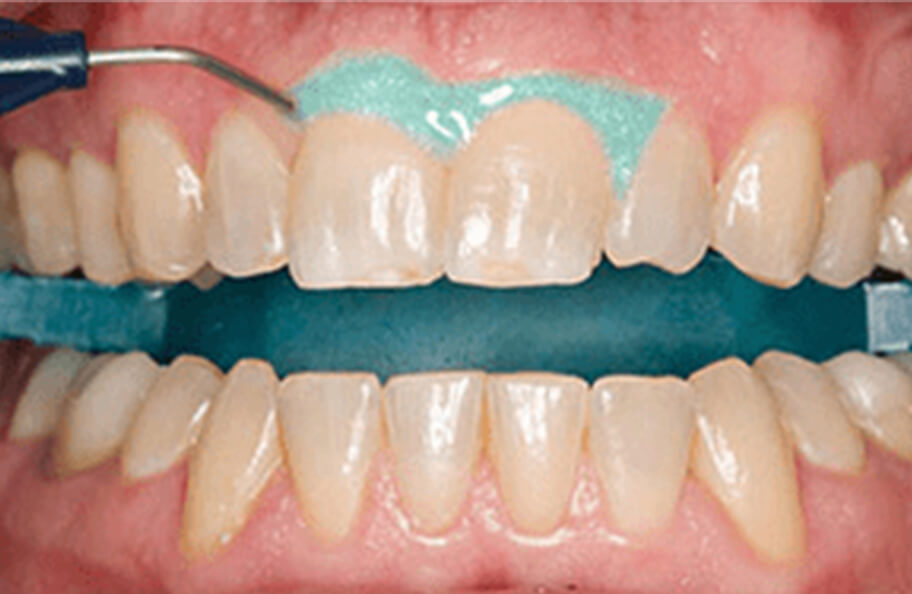 予防歯科のイメージ
